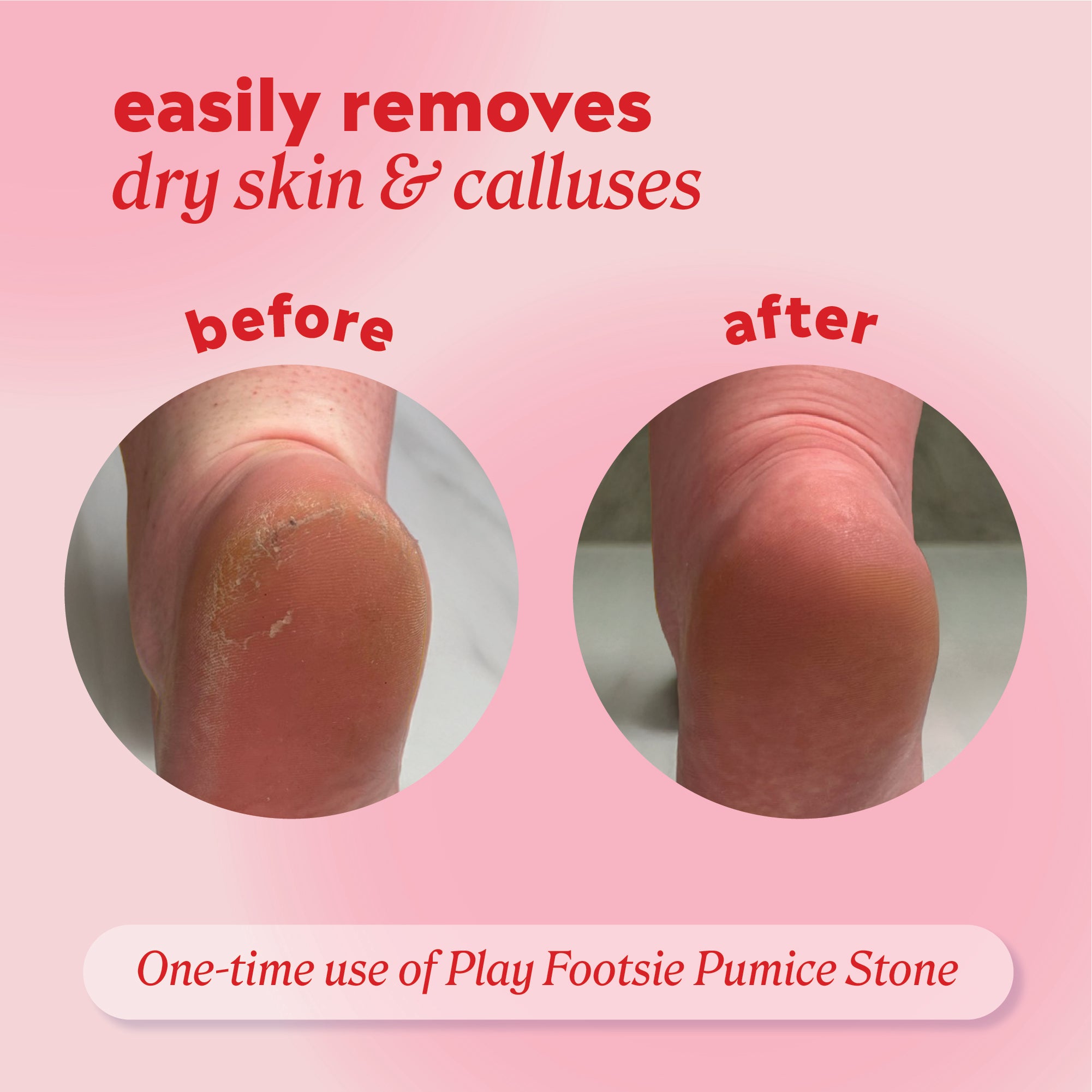 Heel shown “before” and “after” using the pumice stone with header text “easily removes dry skin & calluses” and note “One‑time use of Play Footsie Pumice Stone.”