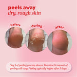 Peels away dry, rough skin. Peeling results shown from a 5 day process labeled “before,” “during,” and “after." 