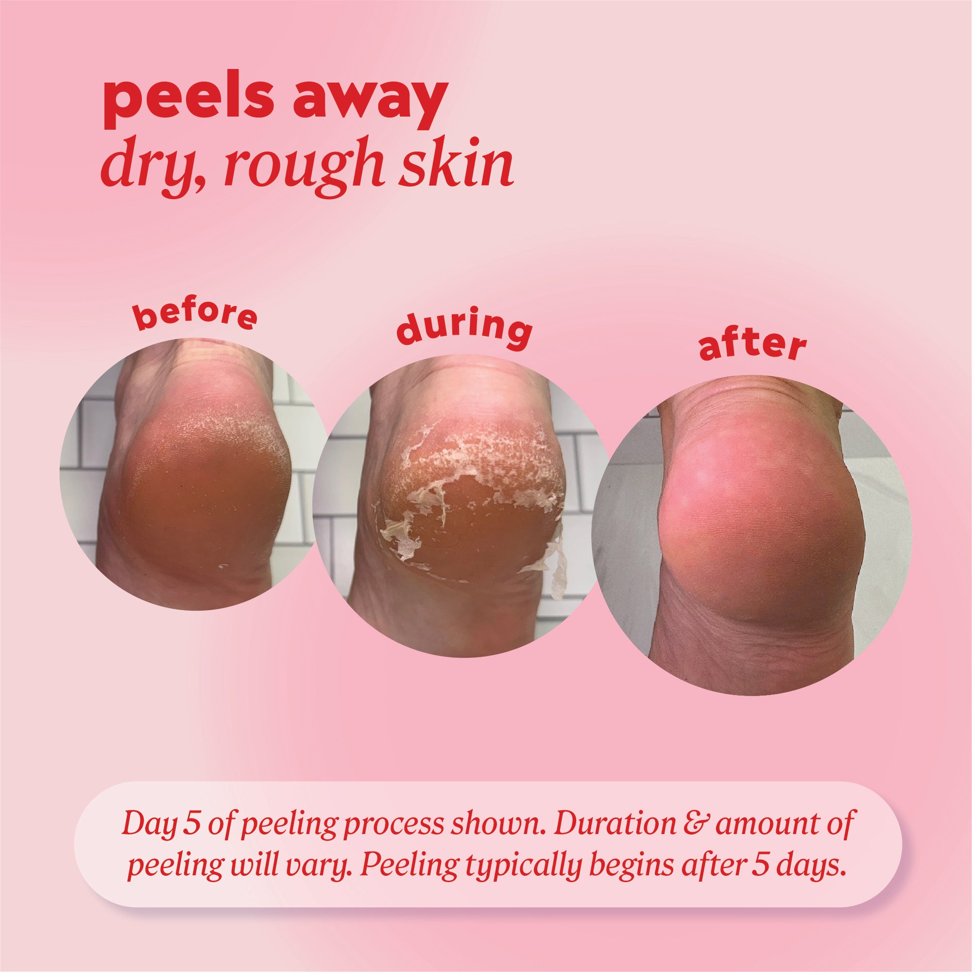 Peels away dry, rough skin. Peeling results shown from a 5 day process labeled “before,” “during,” and “after." 