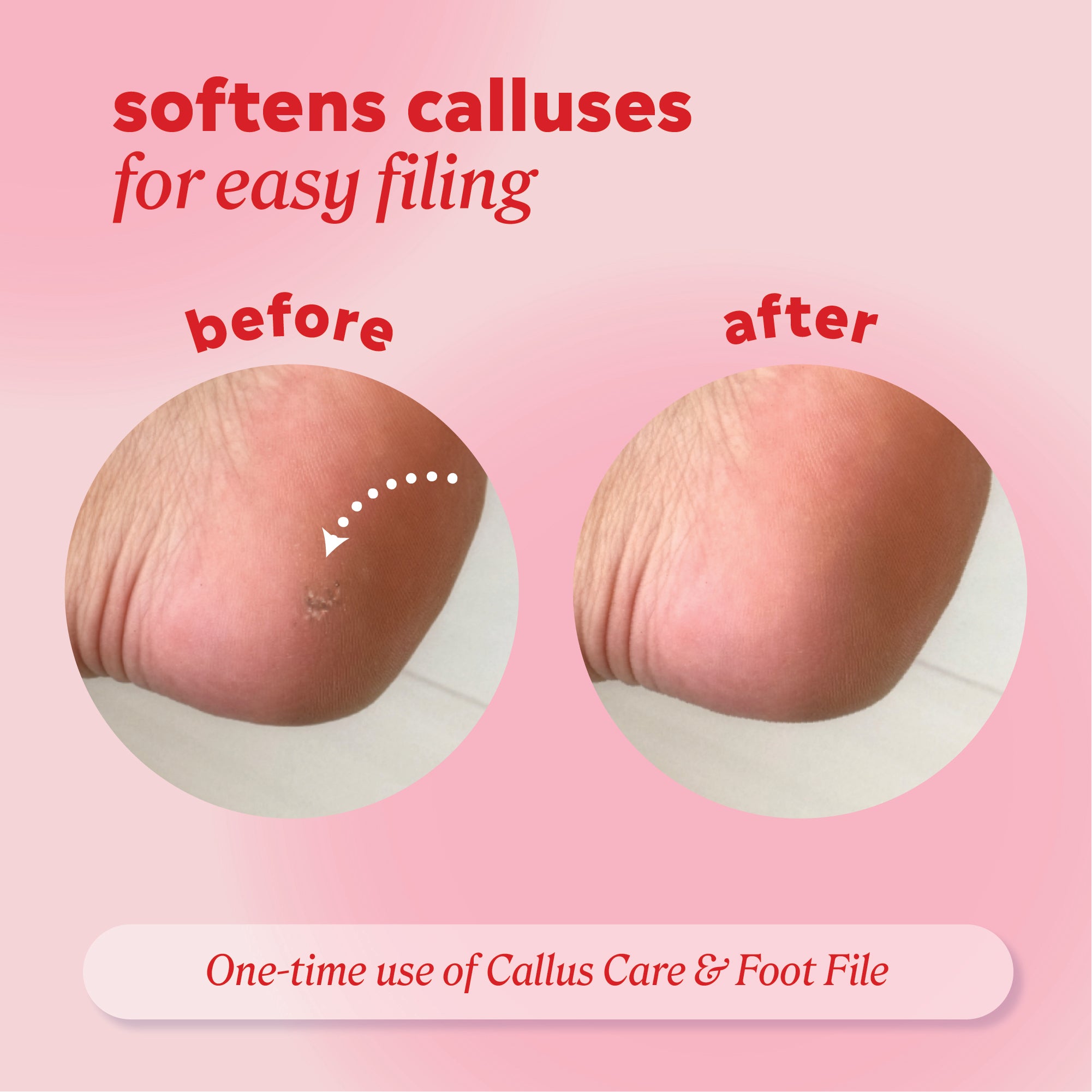 Graphic with the text ‘softens calluses for easy filing.’ Shows a before image of a heel with visible callused skin and an after image of the same heel with the callused area visibly reduced. Text at the bottom reads ‘One‑time use of Callus Care and Foot File.’